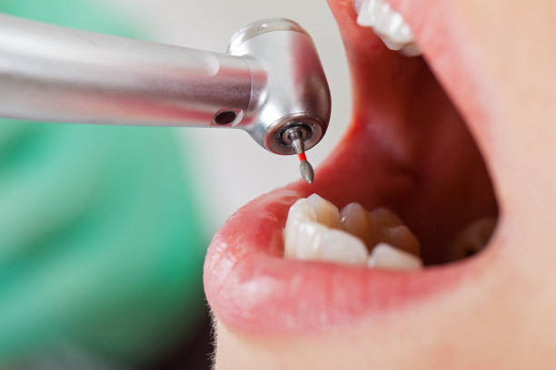Best Knocked-Out Tooth (Avulsed Tooth) Treatment in Brent, FL